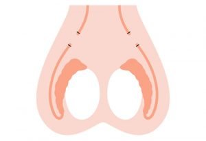 klassieke vasectomie of sterilisatie bij de man