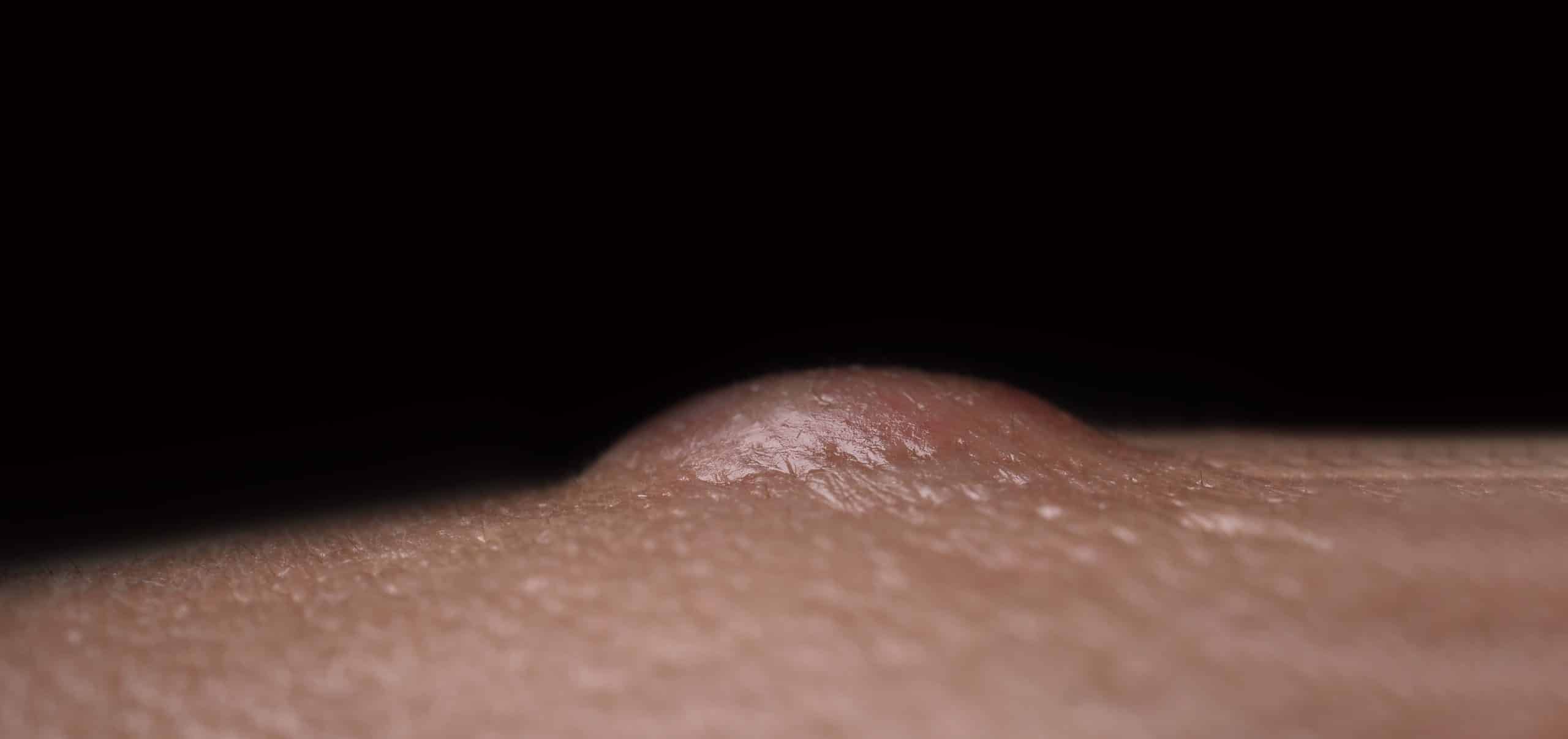 verschil tussen een lipoom en een atheroomcyste